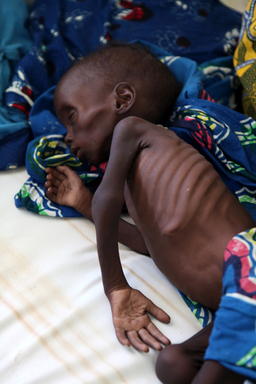 영양실조로 고통받고 있는 니제르 아동